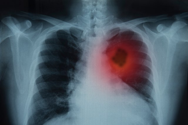 Od njega godišnje umre 4.500 Srba: Rak pluća u ranom stadijumu može otkriti novi test krvi